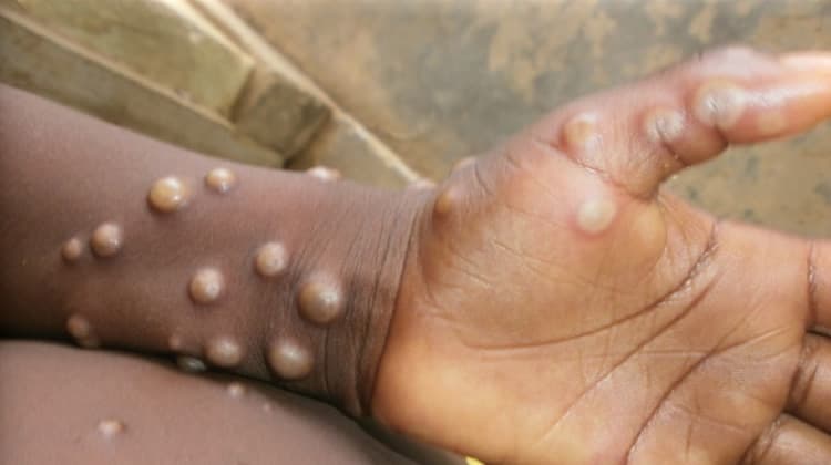 Mpox, quali sono i sintomi e come si trasmette. Oms: “Non chiamare la malattia vaiolo delle scimmie”