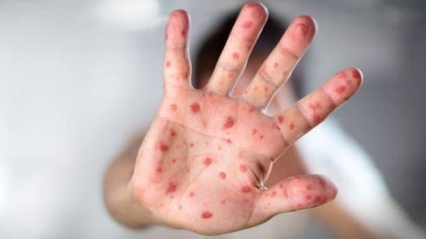 Morbillo: un'epidemia che preoccupa gli esperti