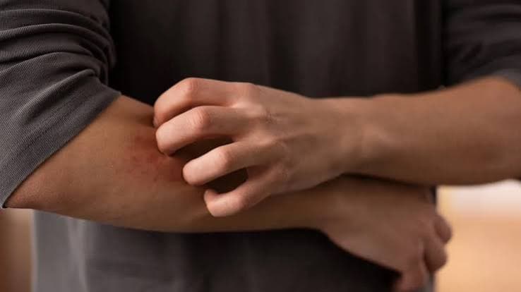 Dermatofilosi, crescono i casi in Europa. Pregliasco: «Rischio basso, ma stanno cambiando le modalità di contagio»
